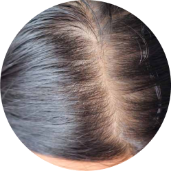 Krooninen / tasainen lisääntynyt hiustenlähtö