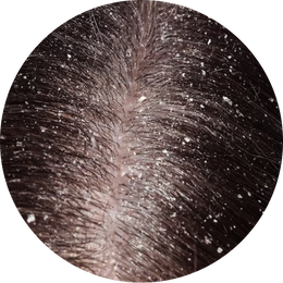 Kuiva hilse (Pityriasis simplex capitis)