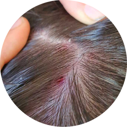 Seborrooinen dermatiitti